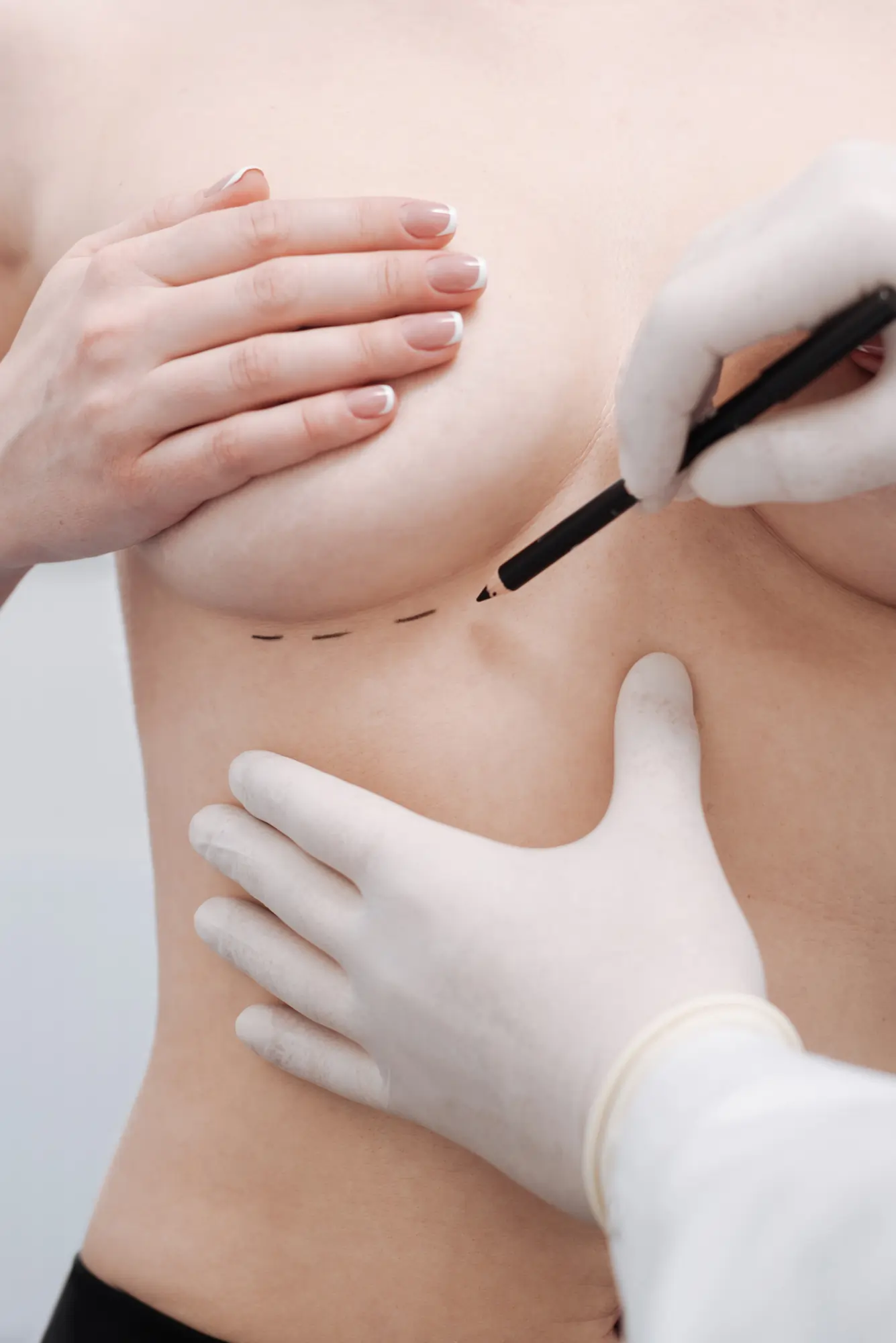 Breast Augmentation Before After Comparison