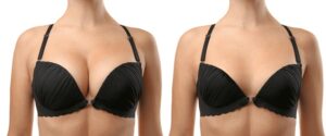 Breast Implants