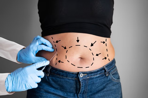 Best liposuction doctors