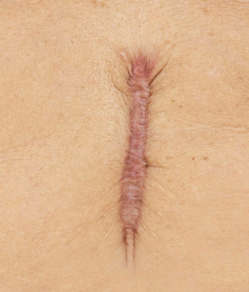 hypertrophic scar treatment