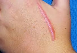 dermatology scar care