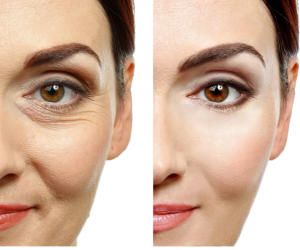 Botox After and before