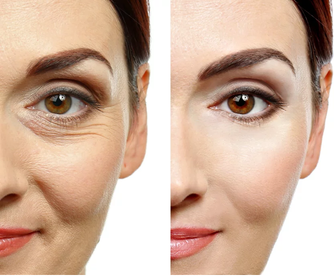 Botox After and before