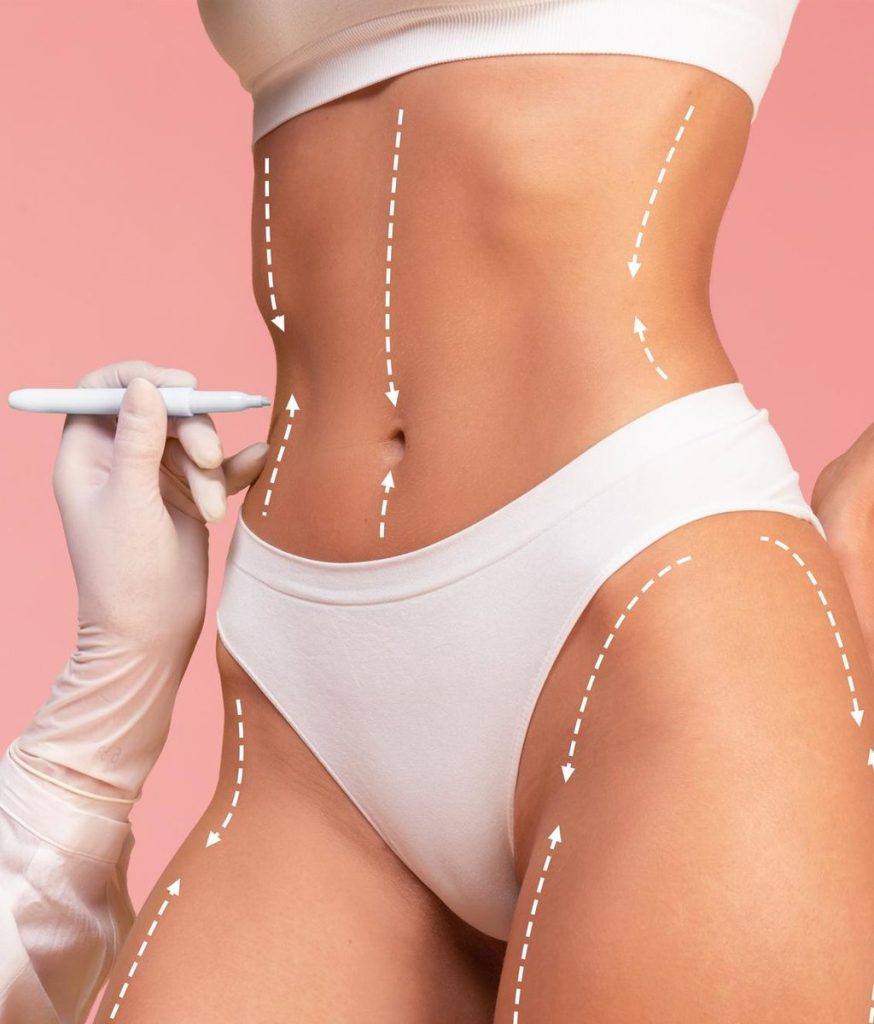 liposuction