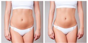 Recovery After Liposuction
