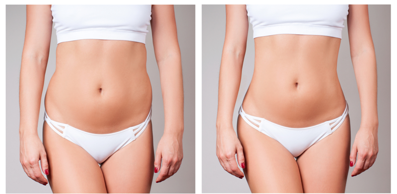 Recovery After Liposuction