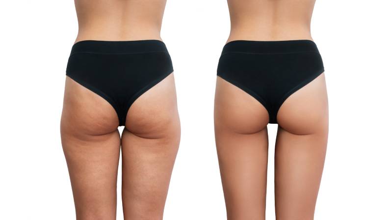 Thigh Lift Surgery