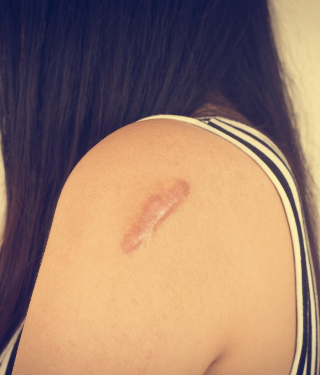 Keloids